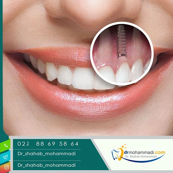 شرایط لازم برای کاندیدای مناسب ایمپلنت دندان: راهنمای جامع